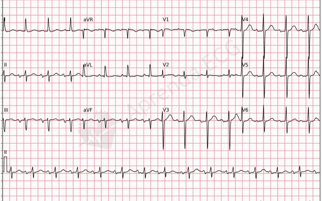 Sobrecarga Ventricular Esquerda