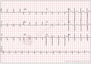 Padrão de  de Winter