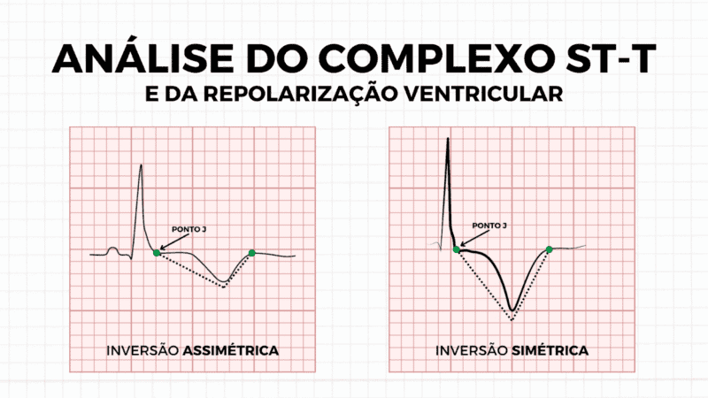 O Novo Paradigma OCA/NOCA: Uma Evolução no Diagnóstico do Infarto do Miocárdio