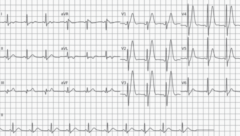 A Confusa Progressão Lenta da Onda R