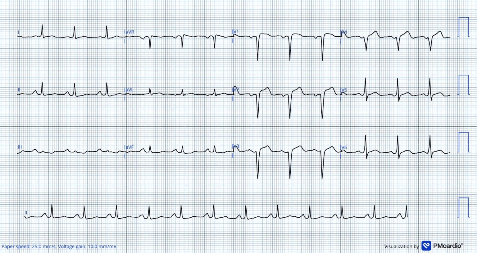 Desafio ECG #2: Qual a parede acometida e a artéria culpada?