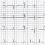 Baixa Voltagem do QRS