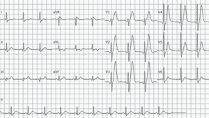 Hemorragia intracraniana