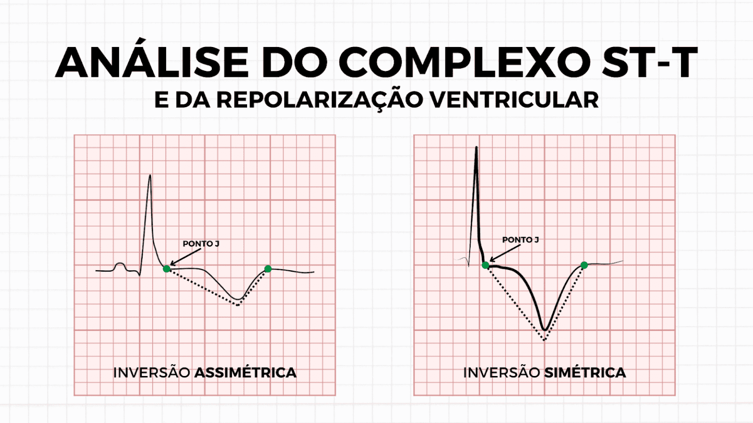 Pré-excitação Ventricular