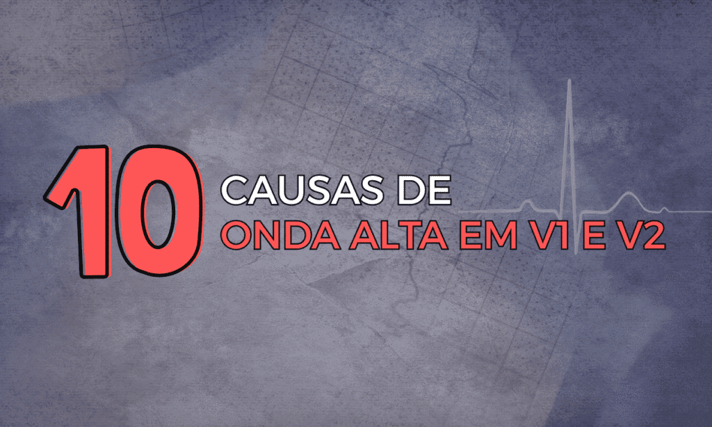 Infradesnivelamento do Segmento ST