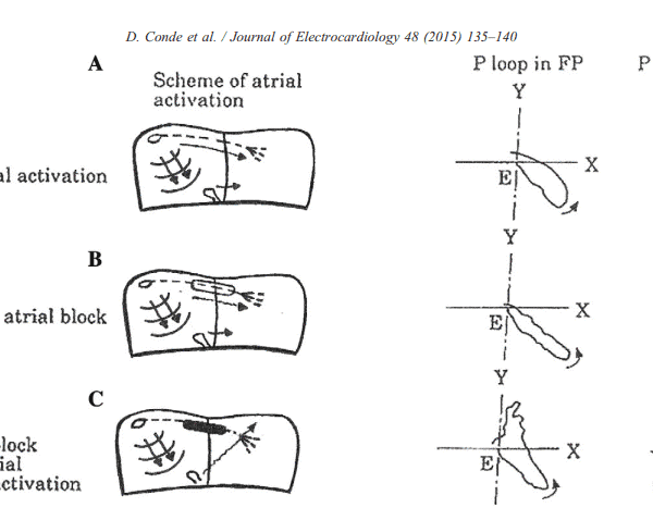 Extrassístole Supraventricular