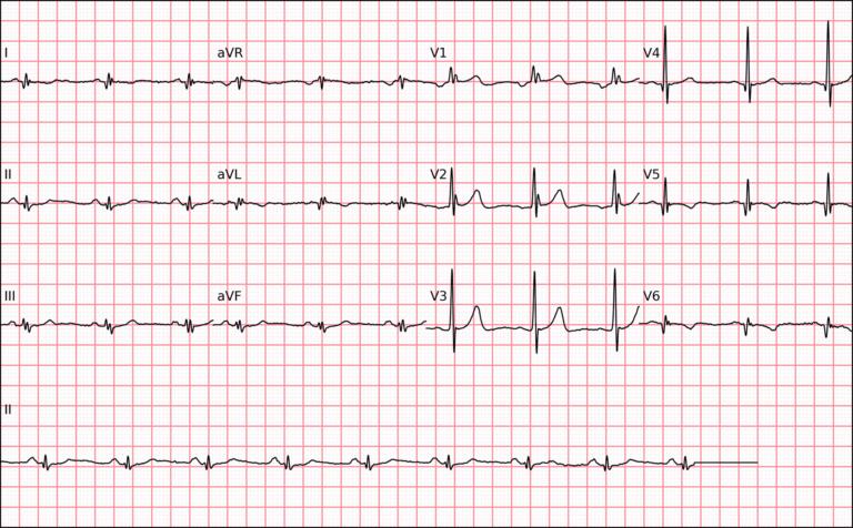 Bloqueio de Ramo Mascarado: Um Diagnóstico Eletrocardiográfico que Merece Atenção