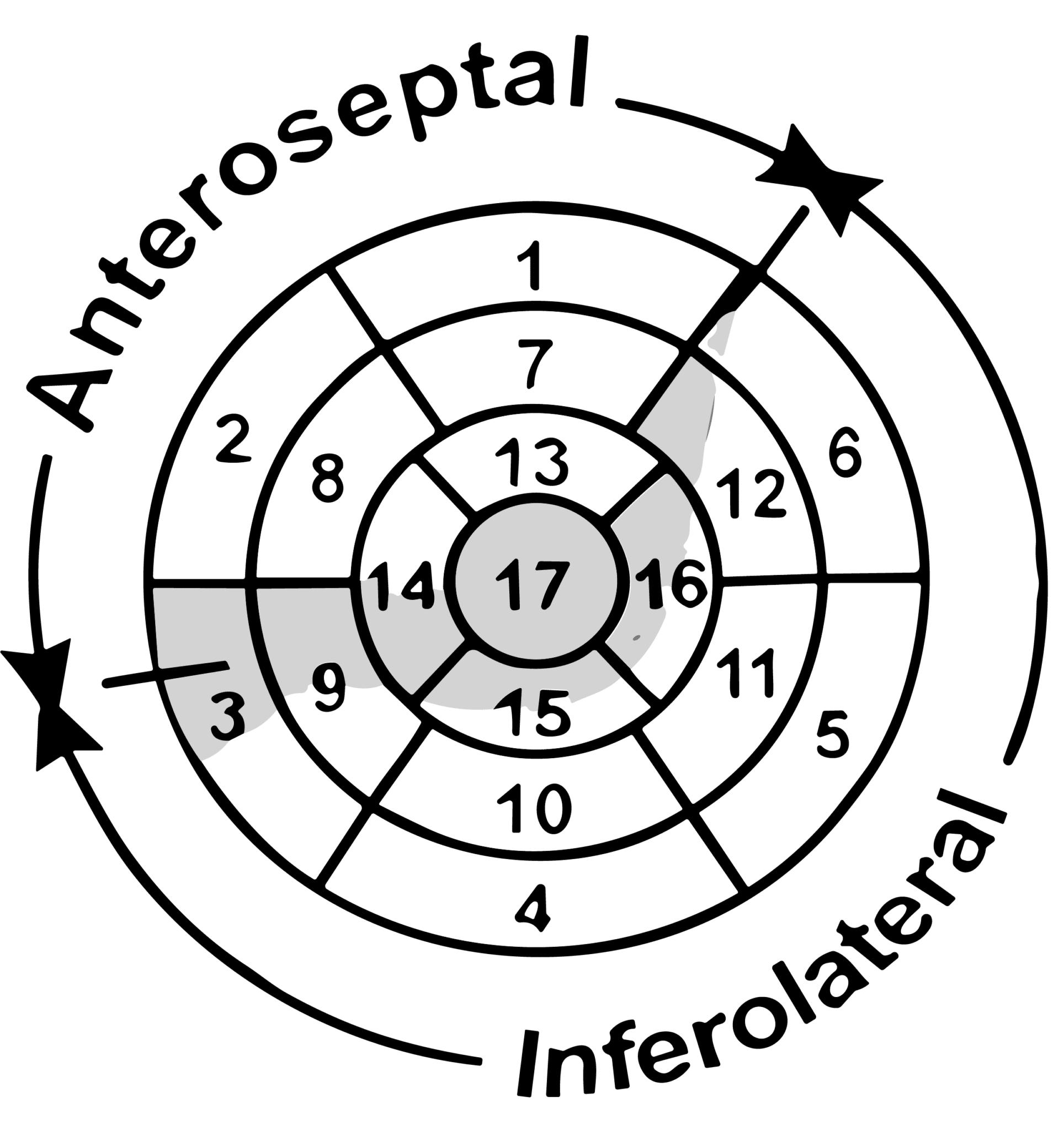 Fragmentação do QRS: Um marcador subestimado no eletrocardiograma