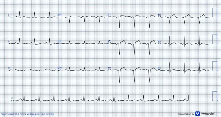Desafio ECG #3: Você consegue identificar as pistas que levaram ao diagnóstico de OCA?