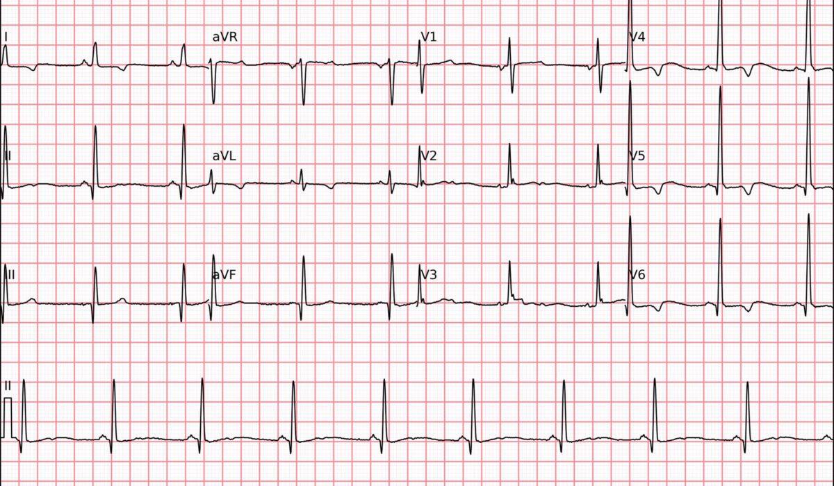Hipercalemia e suas Alterações Eletrocardiográficas: Como o ECG Reflete os Níveis Sérios de Potássio