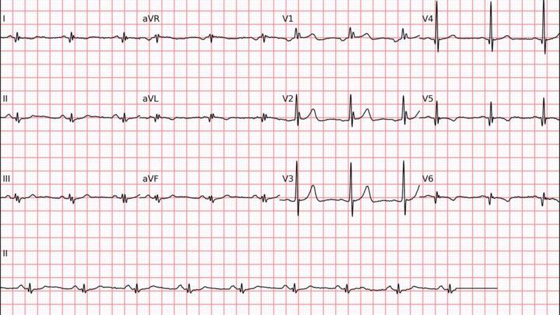 Como Reconhecer o Bloqueio de Ramo Direito no ECG