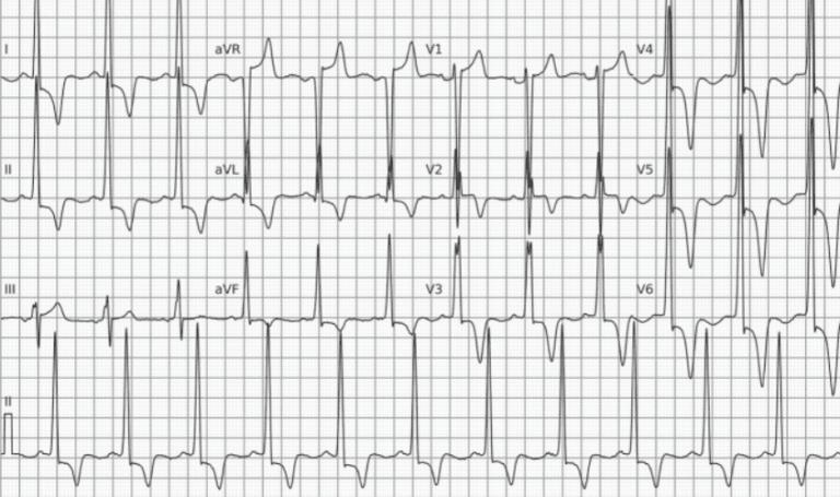 O Eletrocardiograma no Diagnóstico Diferencial da Artéria Culpada no Infarto Inferior