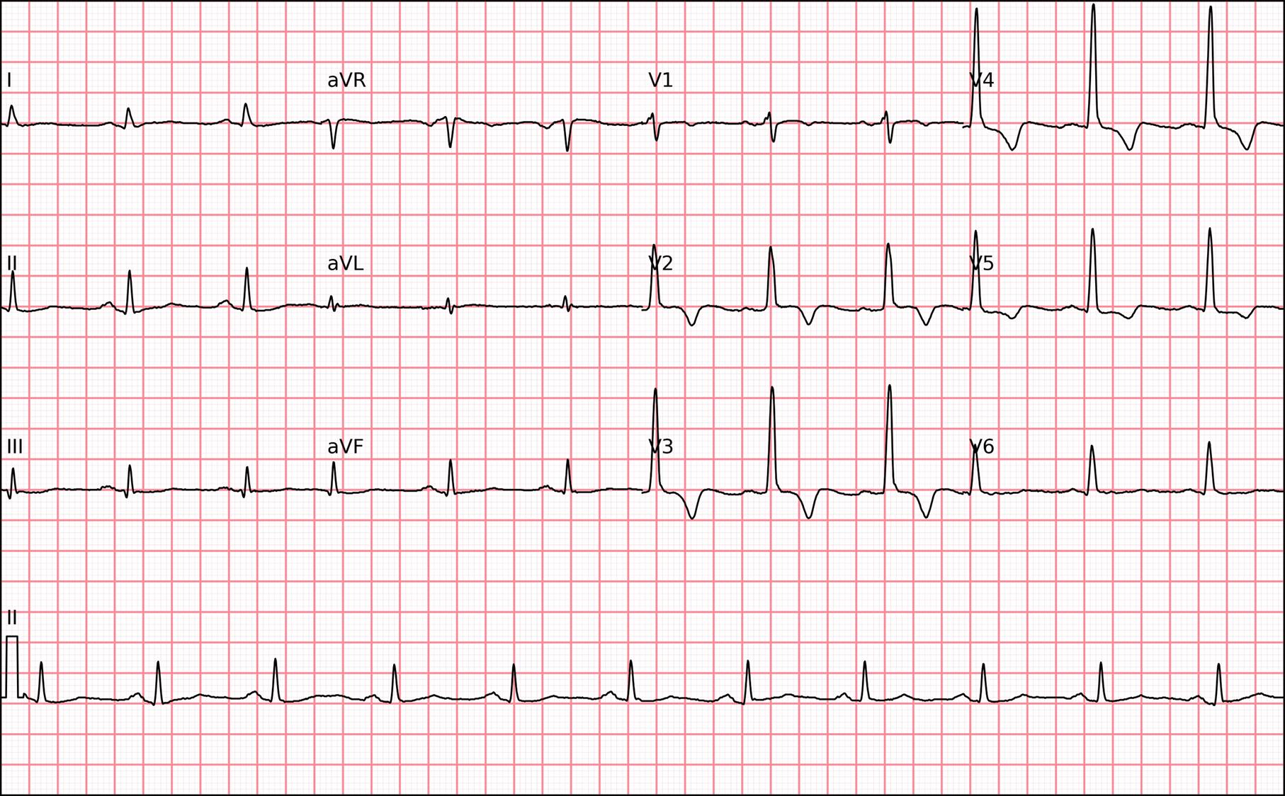 Como Medir o Supradesnivelamento do Segmento ST no ECG