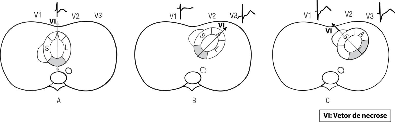 OCA e NOCA: Uma Nova Perspectiva para o Diagnóstico e Tratamento do Infarto Agudo do Miocárdio