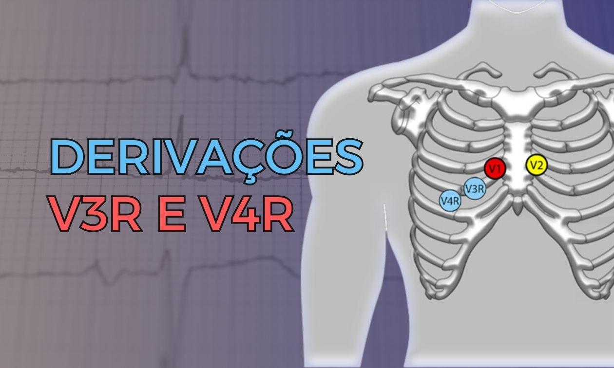 V3R e V4R: Quando utilizá-las e qual o seu papel no diagnóstico de infarto