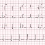 ECG Passo-a-Passo: Cálculo da Frequência Cardíaca
