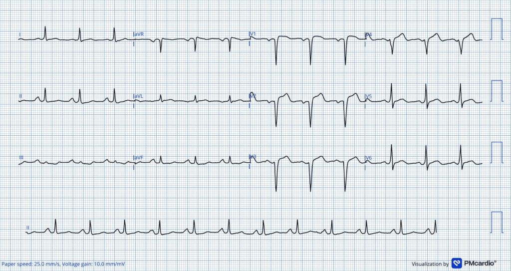 Desafio ECG #4: Um caso de dor torácica e dispneia súbita