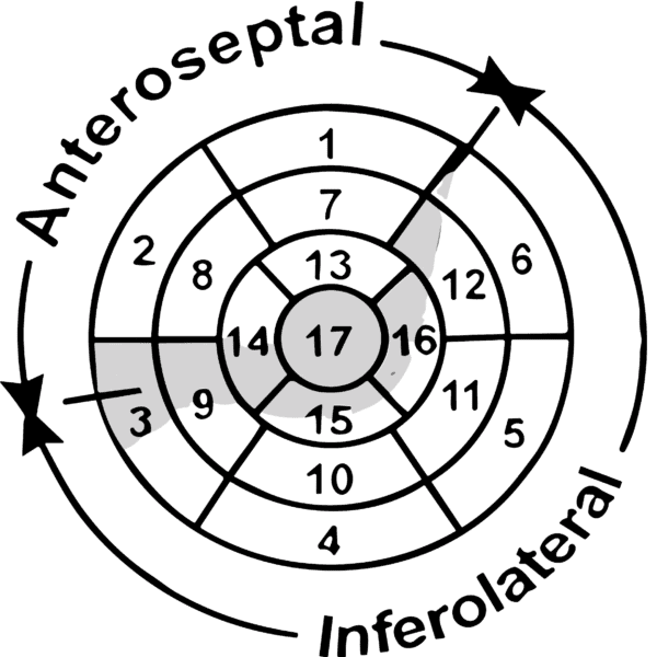 10 Causas de Onda R Alta em V1 e V2