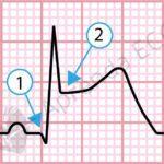 Divergência Precordial: um novo padrão de OCA
