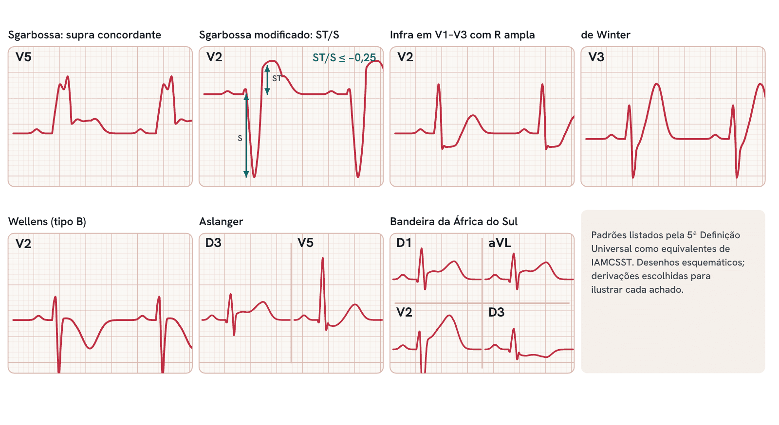 Equivalentes de IAMCSST citados pela 5ª Definição Universal: Sgarbossa, Sgarbossa modificado, infra em V1–V3 com R ampla, de Winter, Wellens, Aslanger e bandeira da África do Sul.