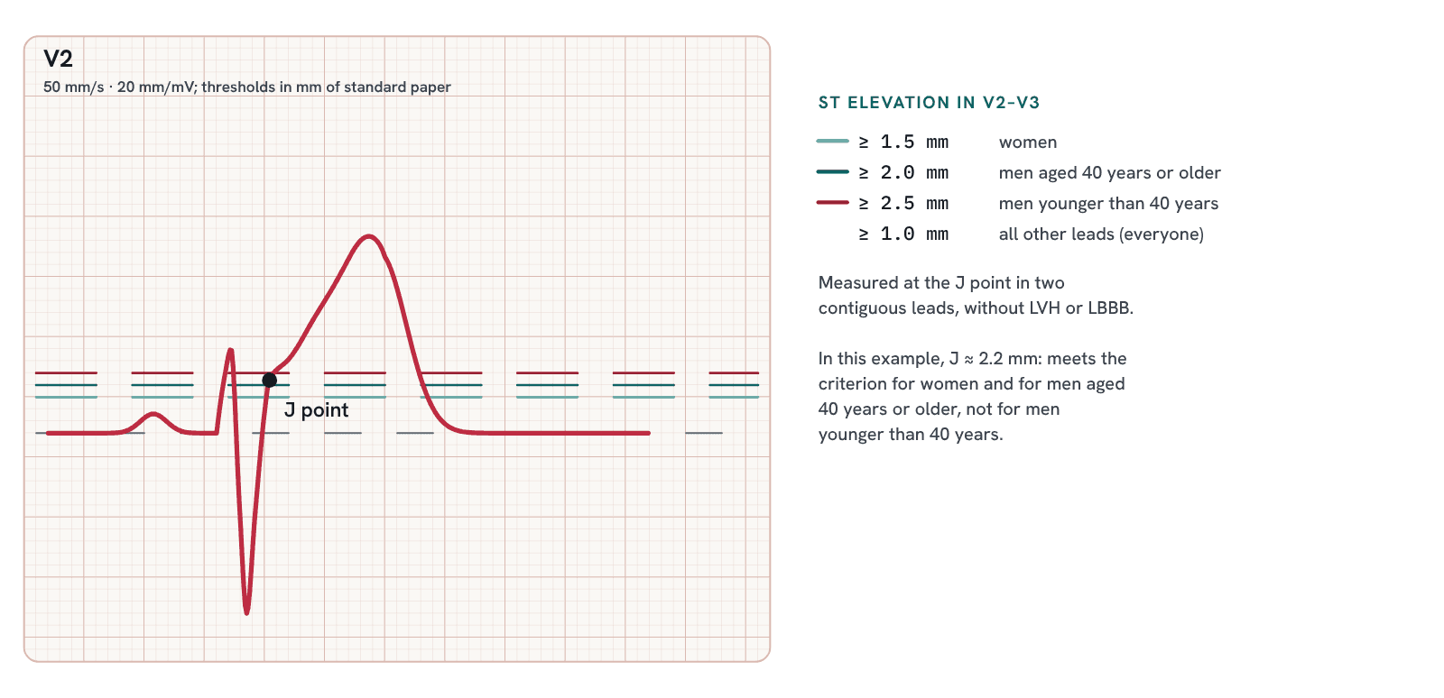 ST elevation in V2 measured at the J point, with the sex- and age-specific thresholds.