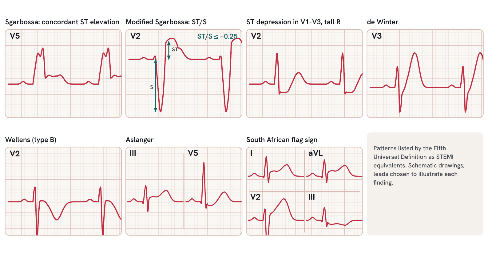 STEMI equivalents cited by the Fifth Universal Definition: Sgarbossa, modified Sgarbossa, ST depression in V1–V3 with a tall R wave, de Winter, Wellens, Aslanger, and South African flag.