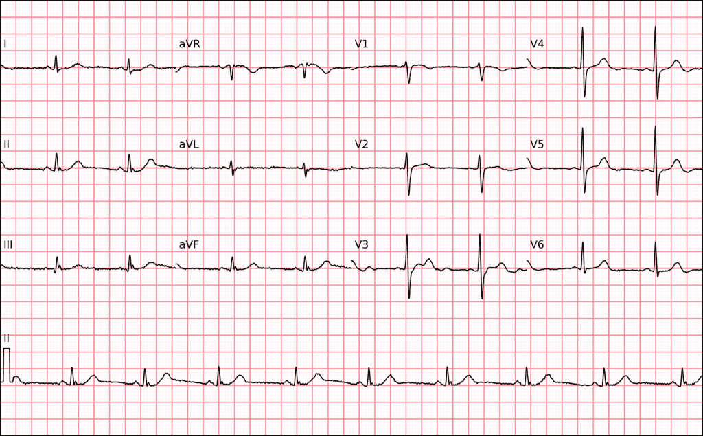 N wave on the ECG