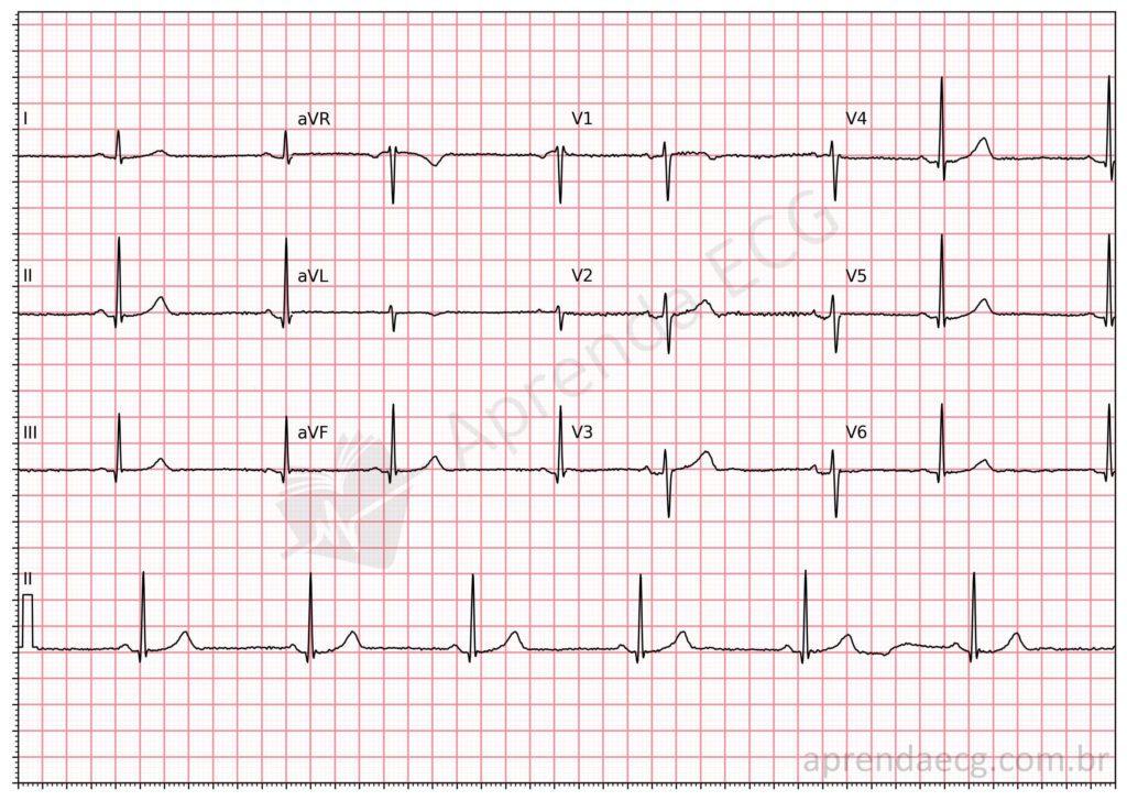 Electrocardiogram showing sinus bradycardia