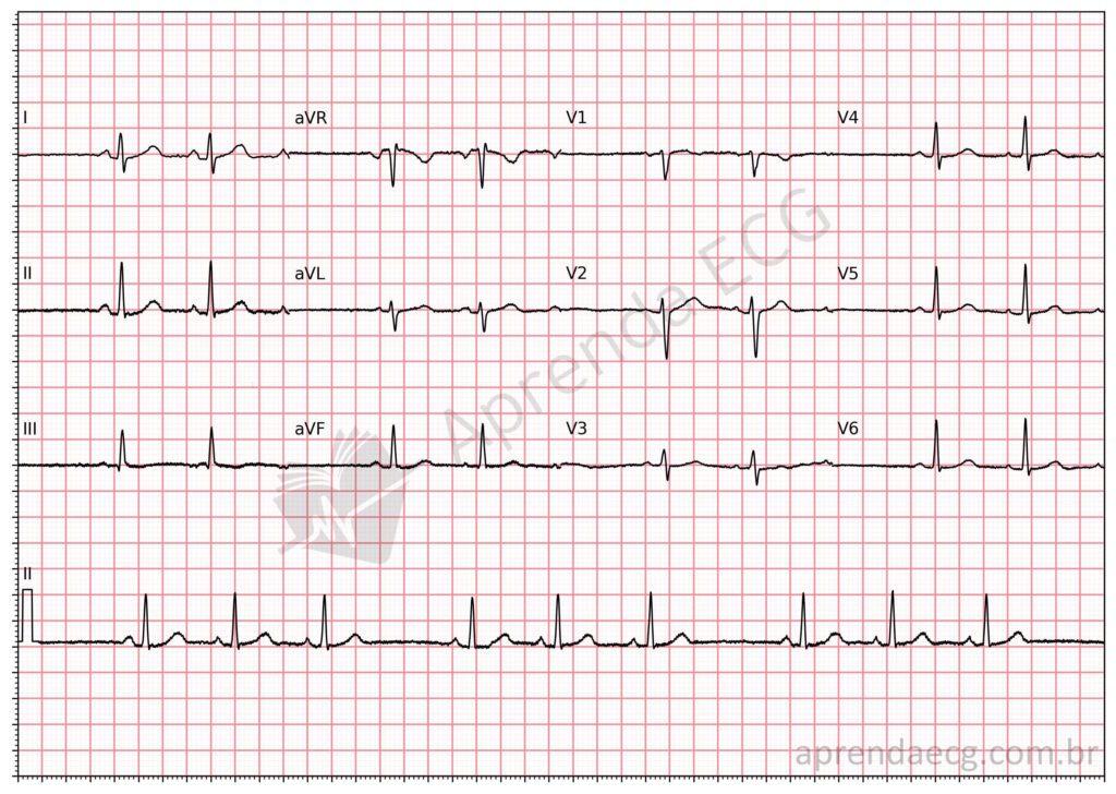 Electrocardiogram showing sinoatrial block