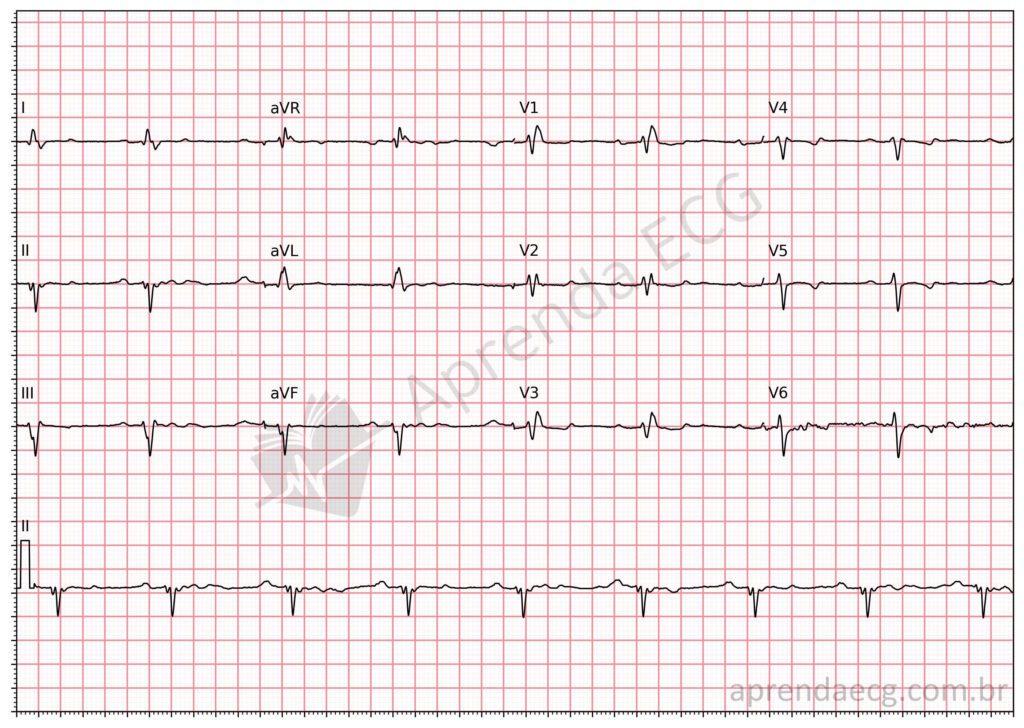Electrocardiograma en la enfermedad de Chagas