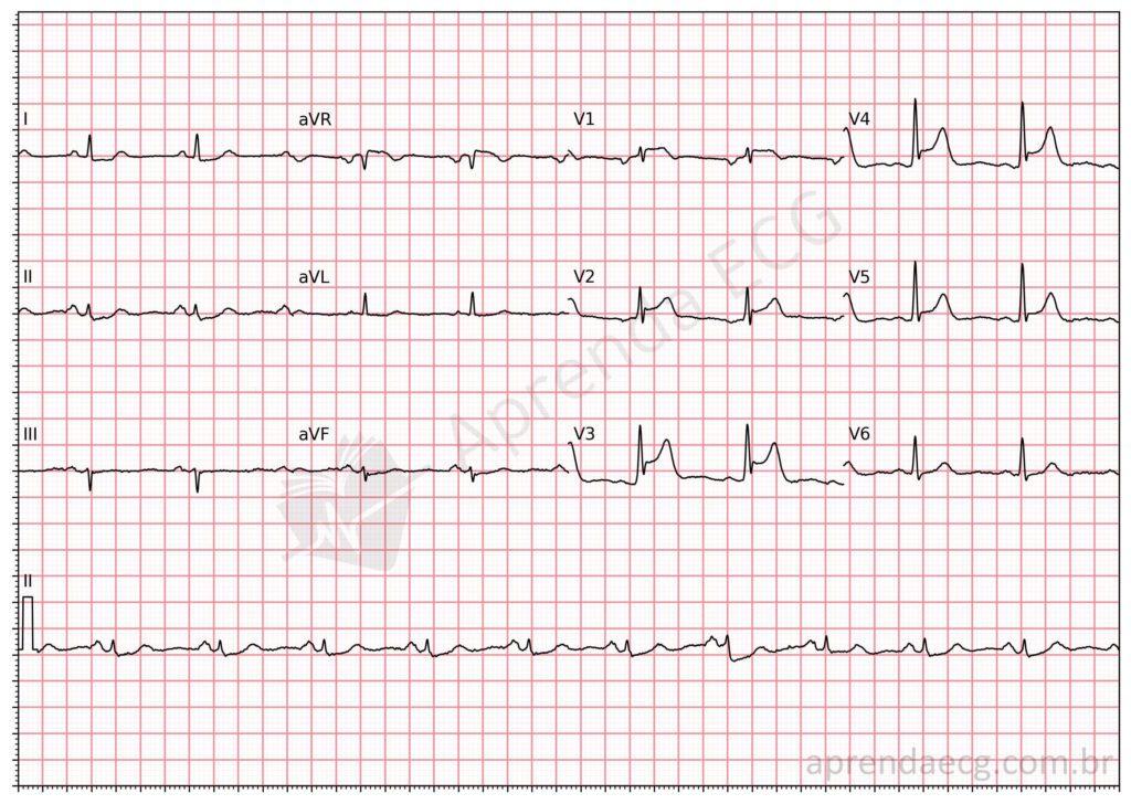 Electrocardiogram showing terminal QRS distortion