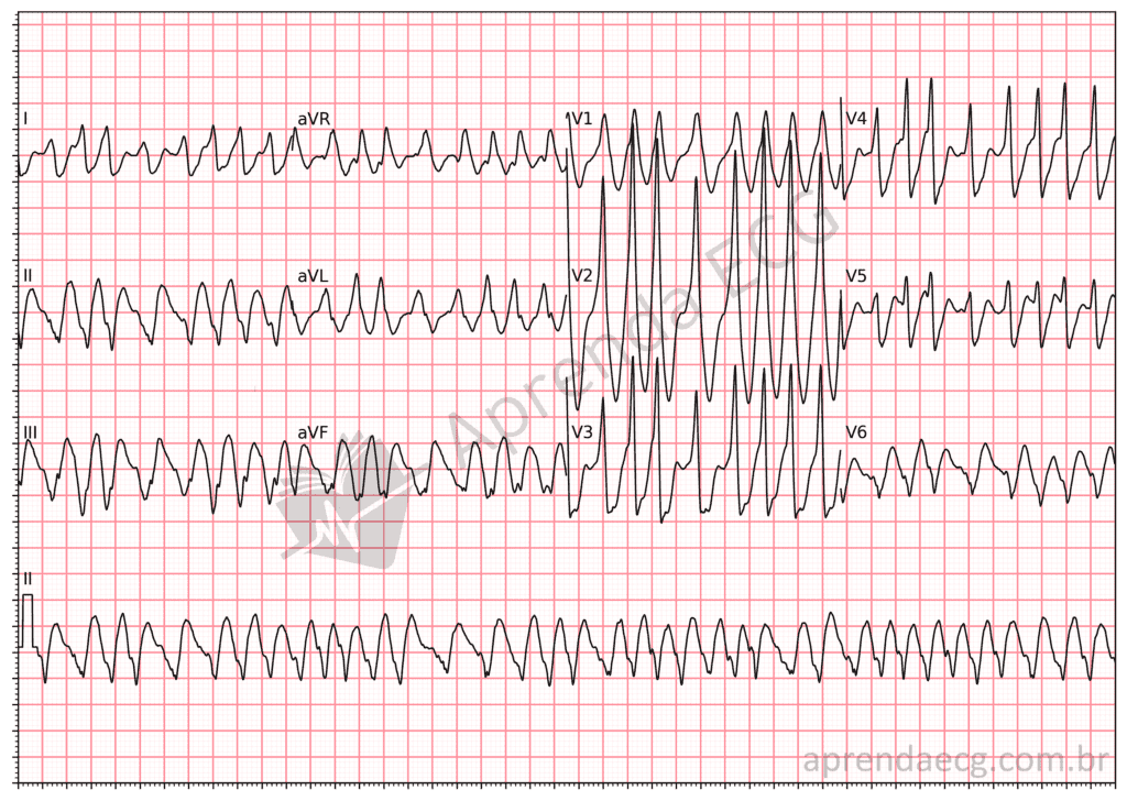 Electrocardiograma con fibrilación auricular preexcitada
