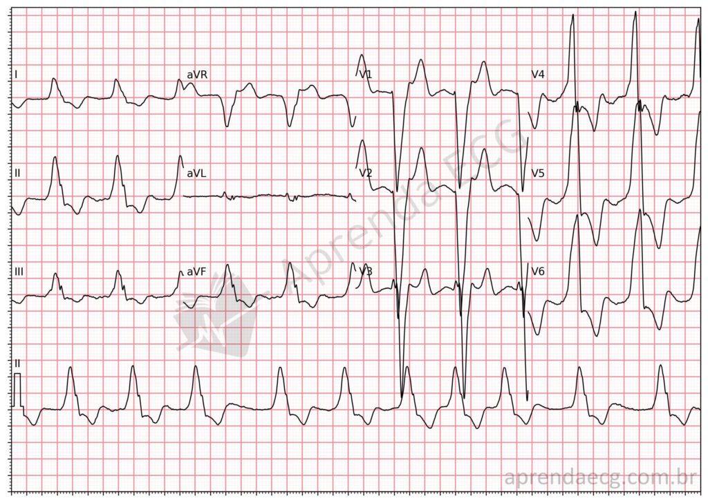Electrocardiograma con fibrilación auricular y bloqueo de rama izquierda