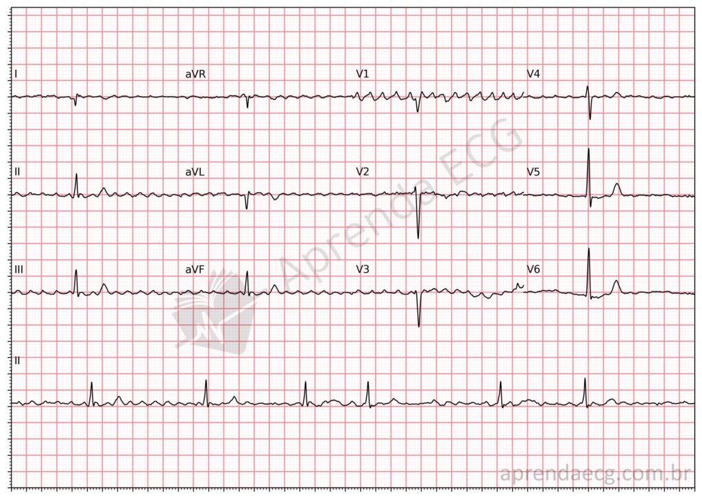 Electrocardiograma con fibrilación auricular