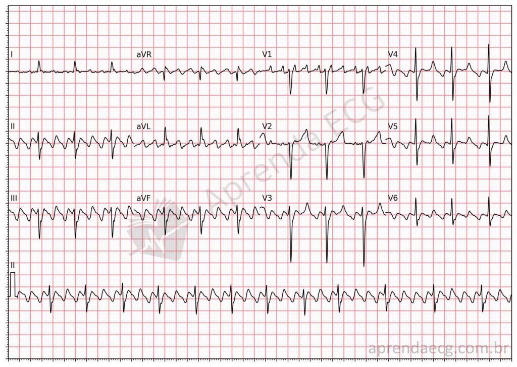 Electrocardiogram showing atrial flutter