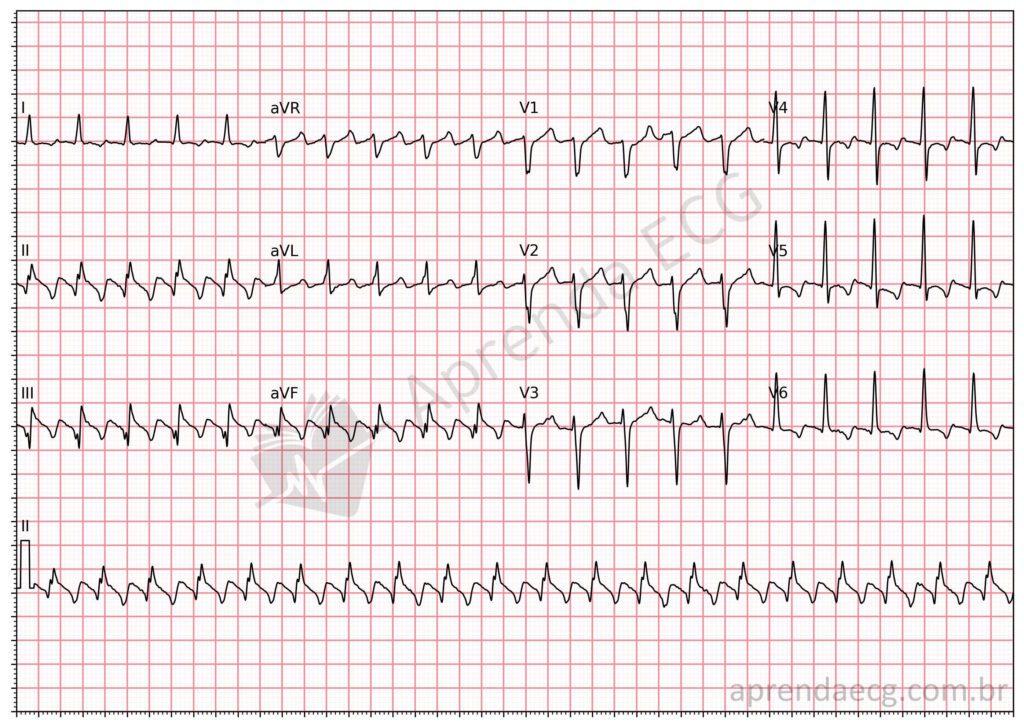 Electrocardiogram showing atrial flutter