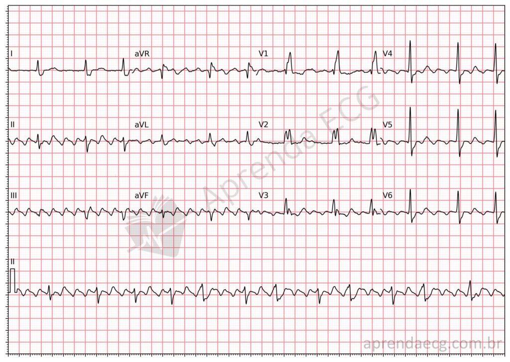Electrocardiogram showing atrial flutter