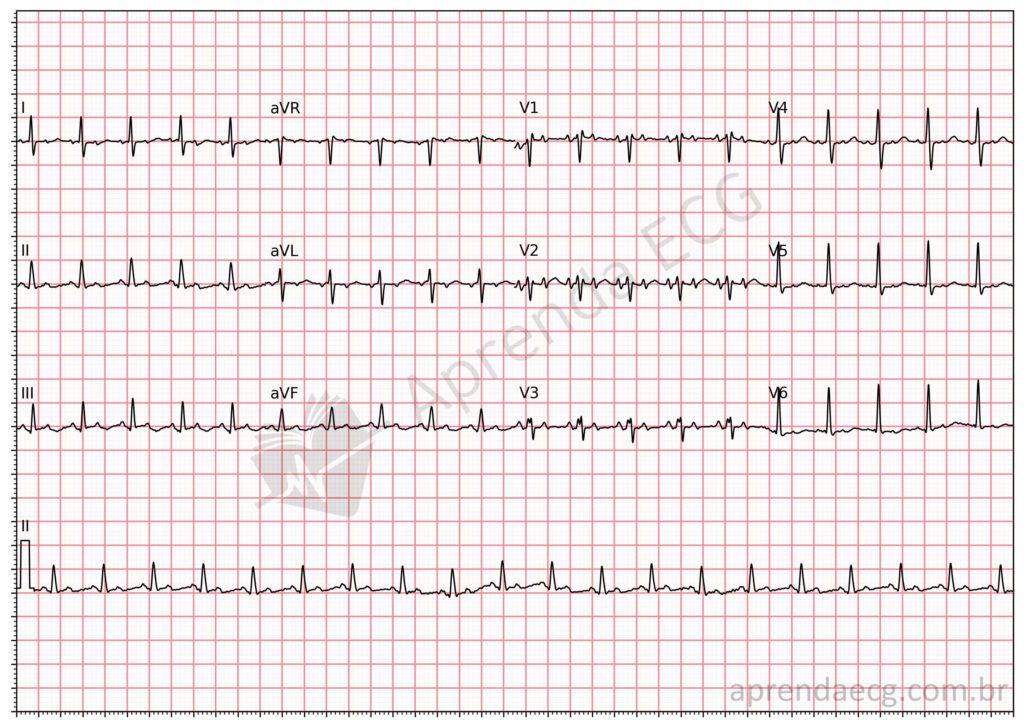 Electrocardiogram with focal atrial tachycardia