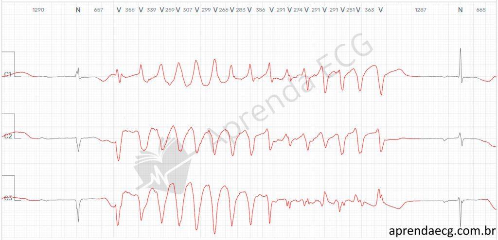 Electrocardiogram with torsades de pointes