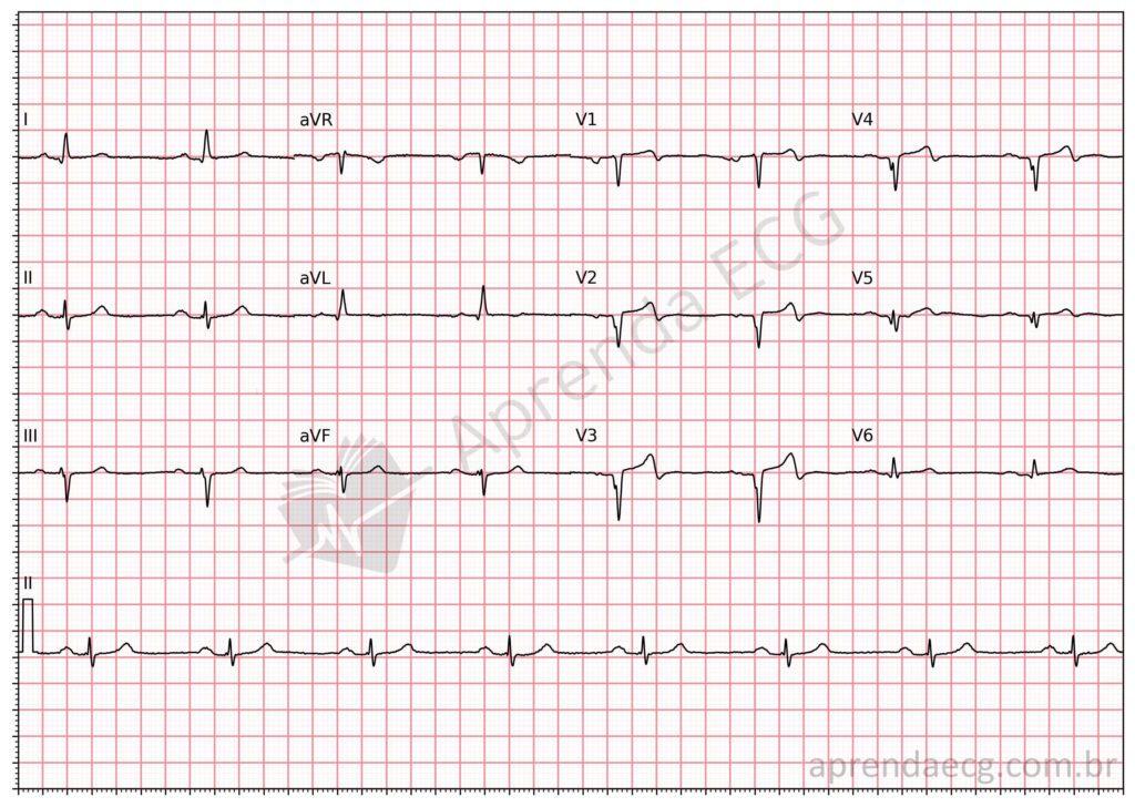 Electrocardiogram with an anteroapical electrically inactive area (Q wave)