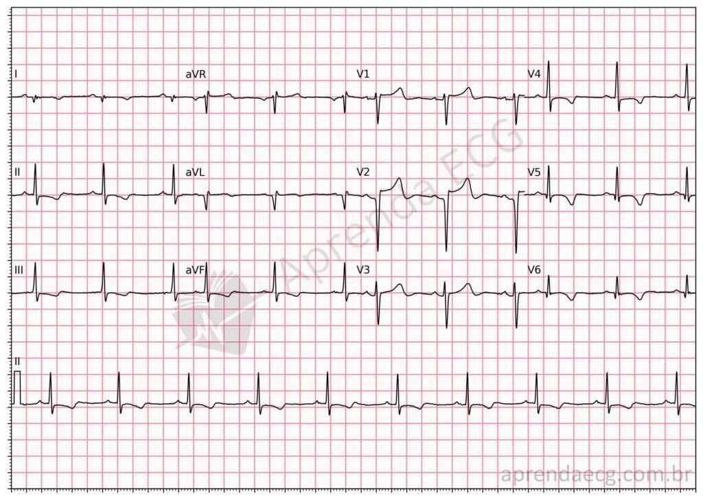Electrocardiogram with a mid-anterior electrically inactive area (Q wave)