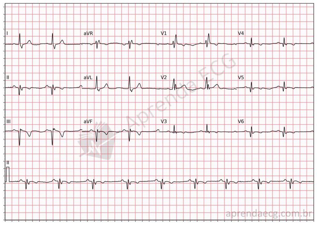 Electrocardiogram with an inferior electrically inactive area (Q wave)
