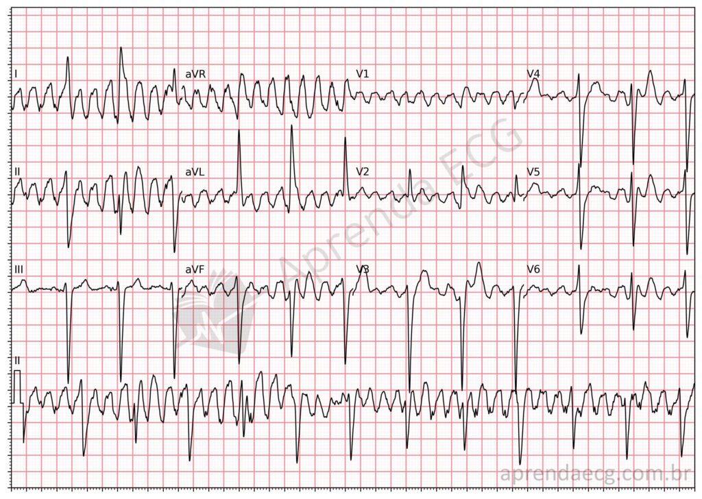 Electrocardiogram with artifact