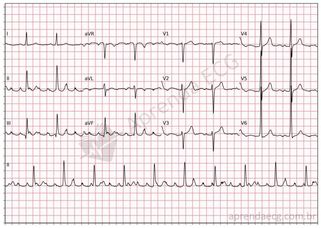 Electrocardiogram with artifact