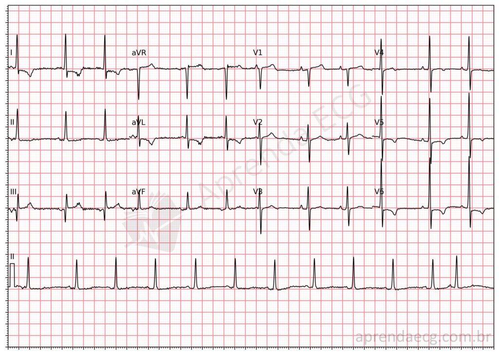 Electrocardiogram showing the Aslanger pattern