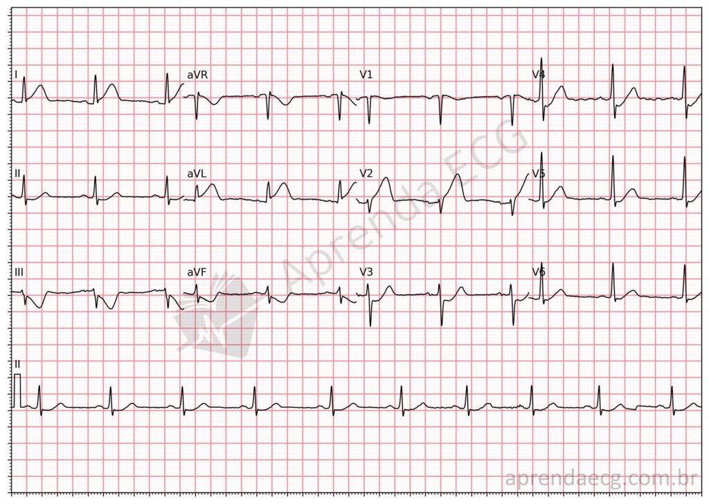 Electrocardiogram showing the South African flag sign and mid-anterior wall infarction