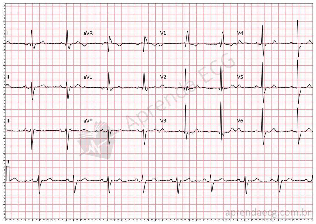 Electrocardiograma con bloqueo de rama derecha (BRD) asociado a hemibloqueo anterior izquierdo (HAI)