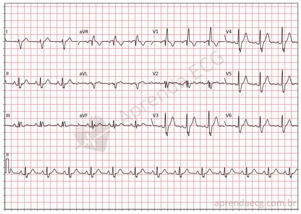 Electrocardiograma con bloqueo de rama derecha (BRD) asociado a hemibloqueo posterior izquierdo (HPI)