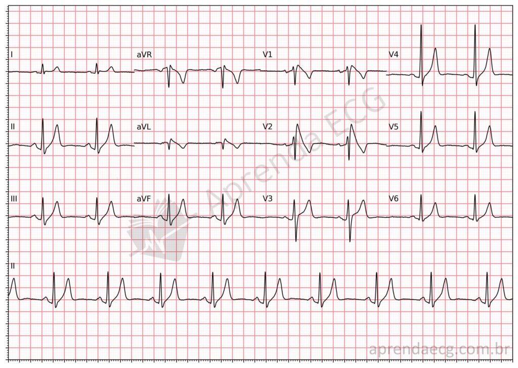 Electrocardiogram with type 1 Brugada pattern