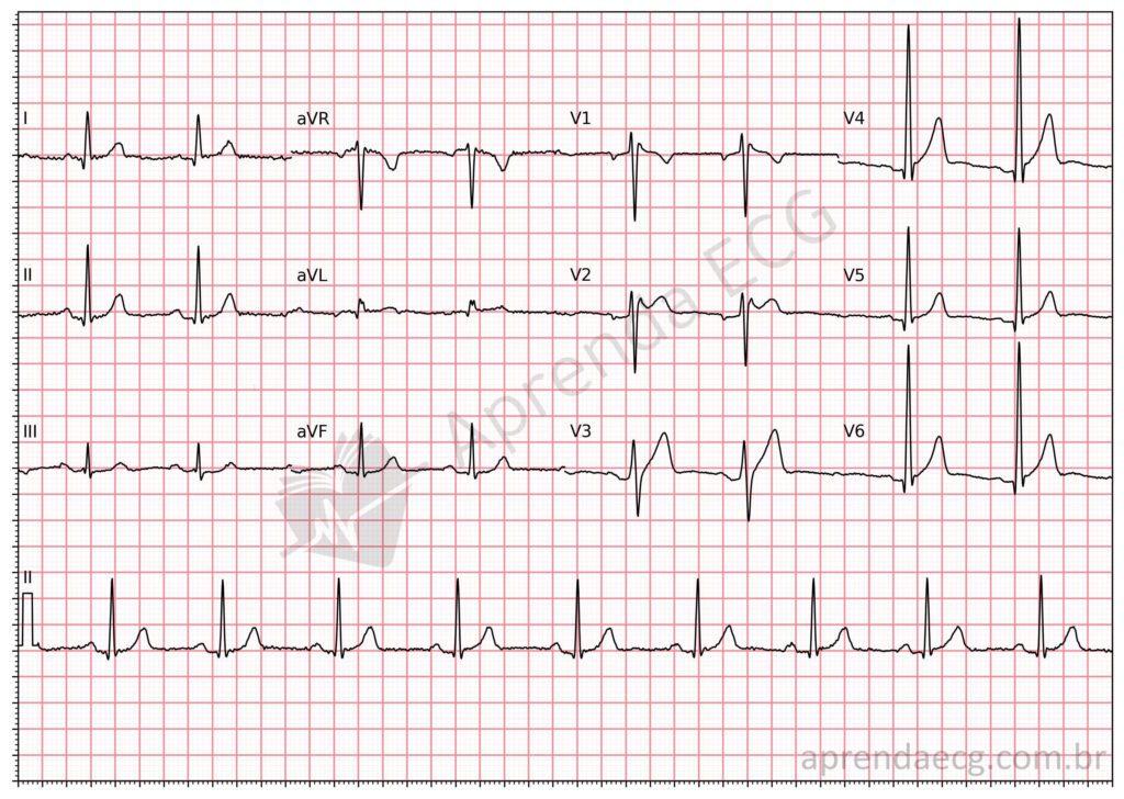 Electrocardiogram with type 2 Brugada pattern